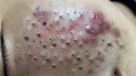 More specifically, they are open comedones. . Nasty disgusting blackheads
